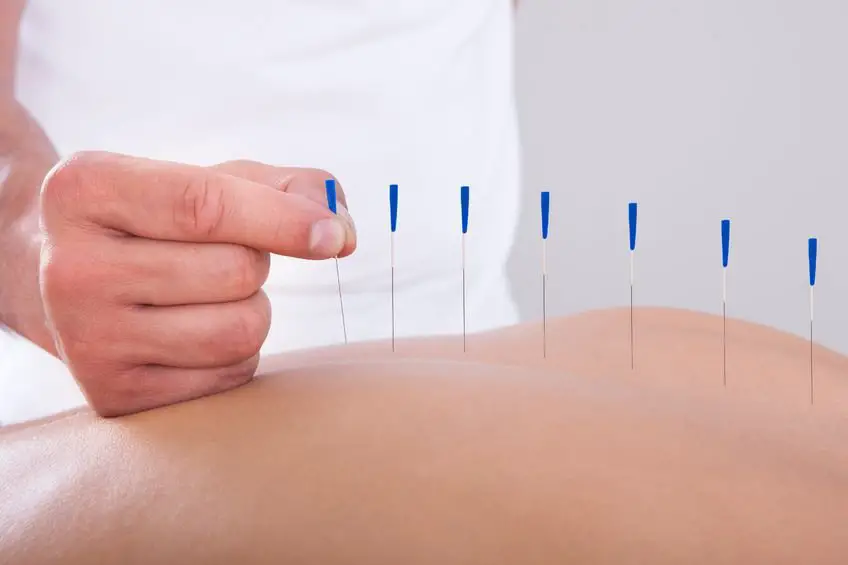 Is Acupuncture Effective in Treating Lower Back Pain