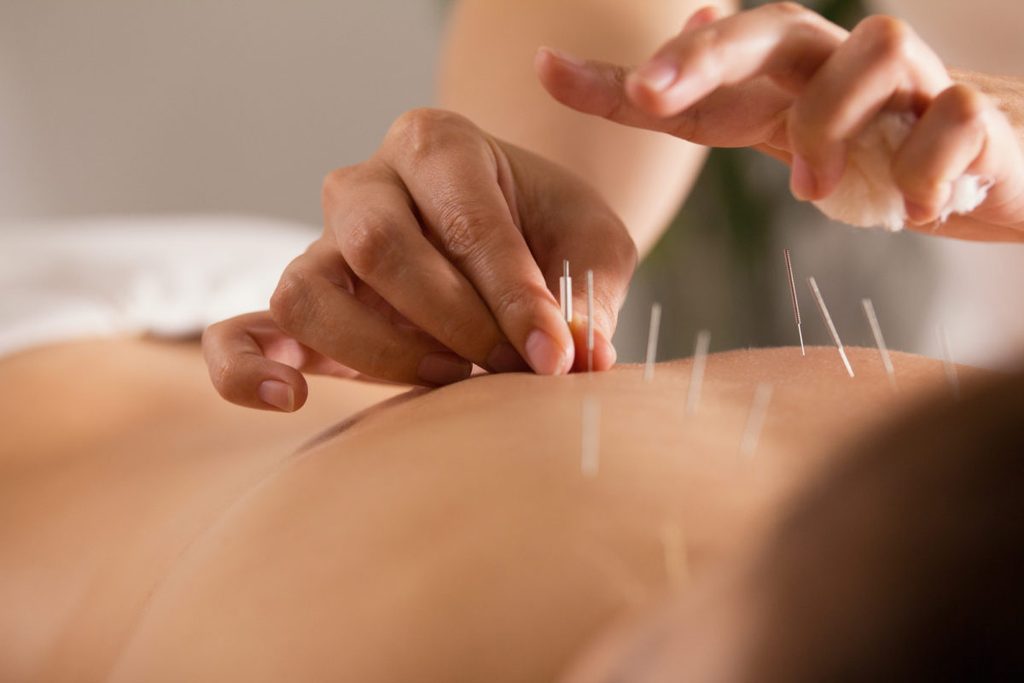 Is it Effective to Use Acupuncture for Lower Back Pain ...