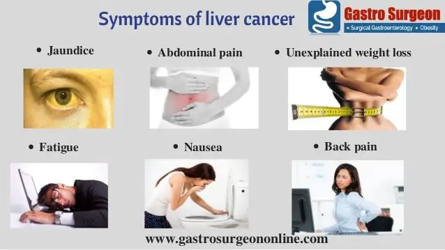 Liver Cancer Treatment In Chennai