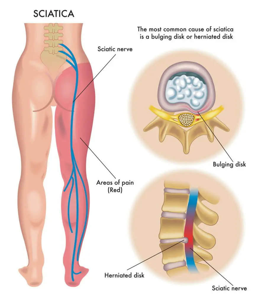Lower Back And Leg Pain Are Typical Sciatica Symptoms ...