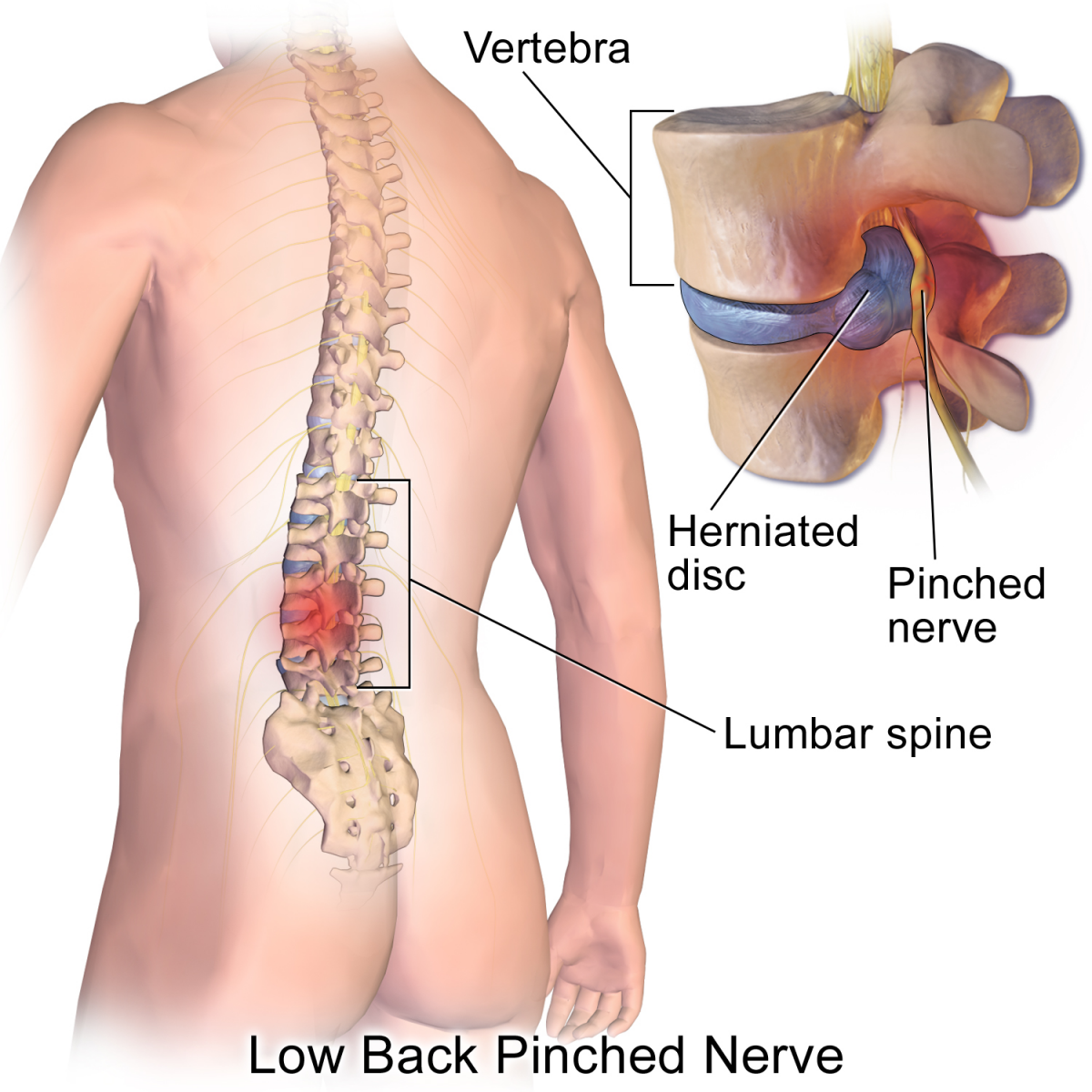 Lower Back Disc Herniation