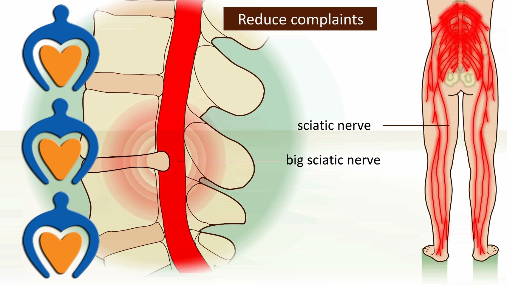 Lower back pain (a.o. sciatica, herniated disk)