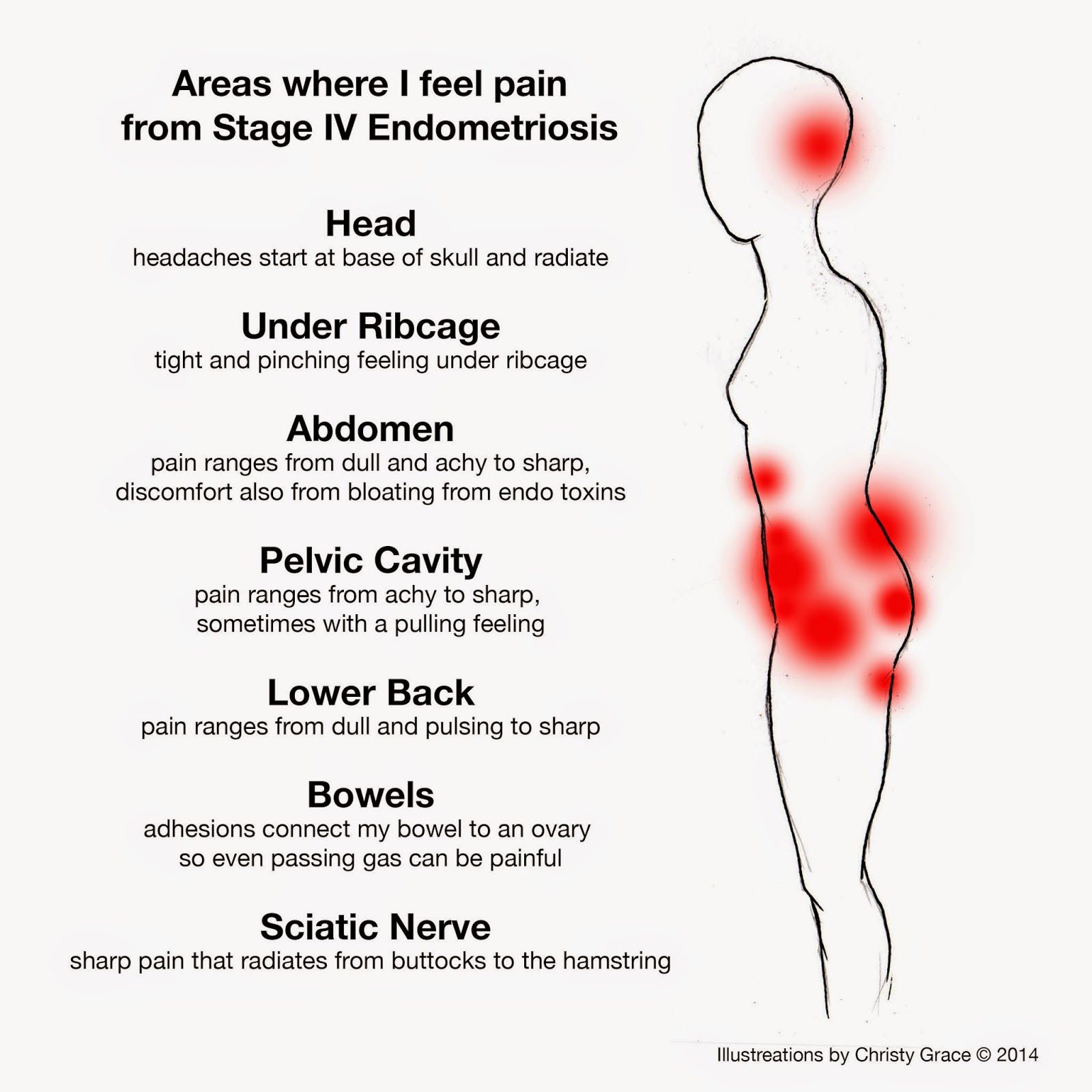 Lower Left Back Pain Female Endometriosis