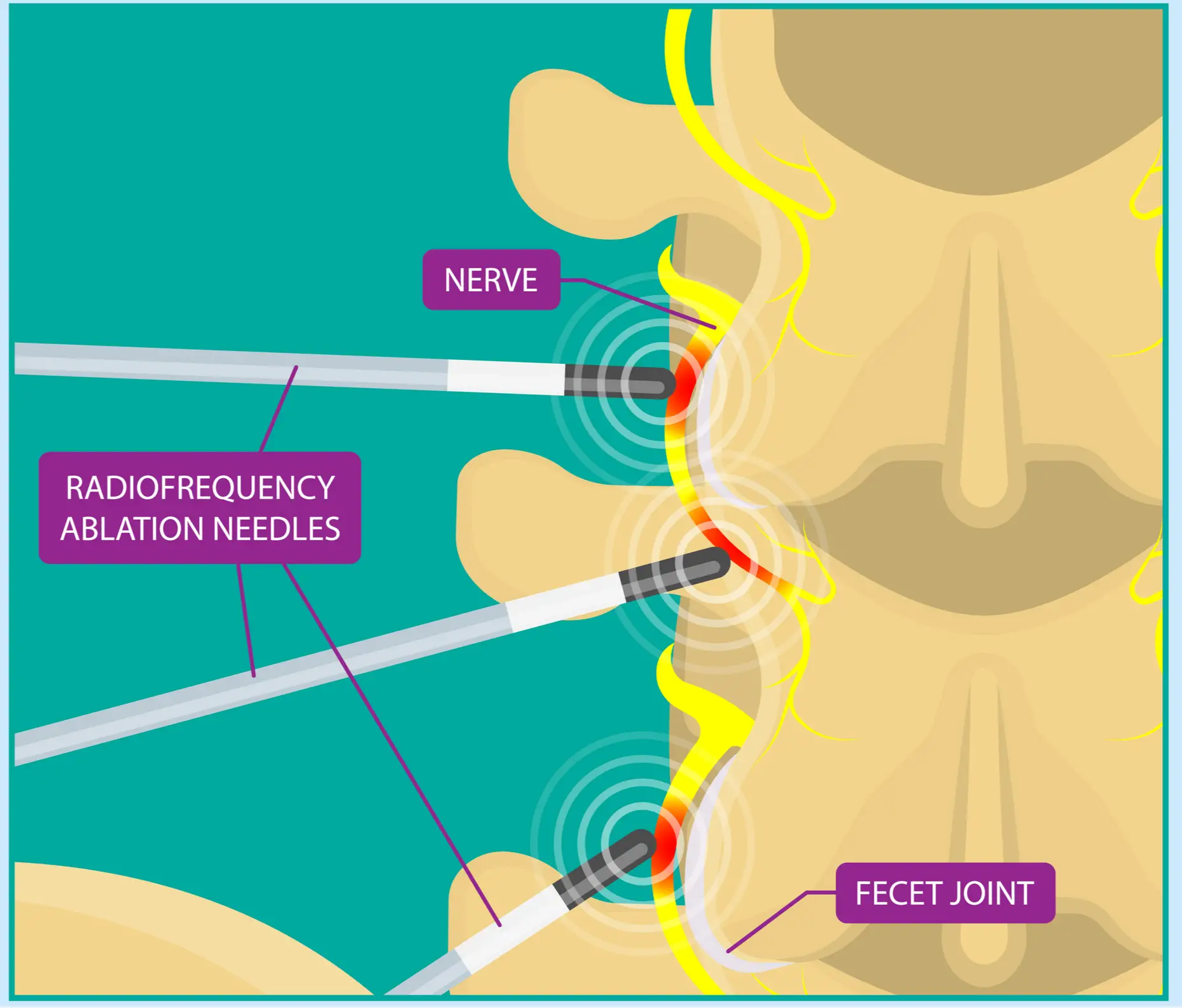 Lumbar Facet Radiofrequency Neurotomy