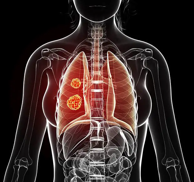Lung cancer symptoms: Nine early warning signs you should NEVER ignore ...