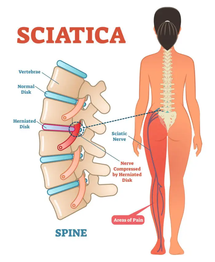 Massage for Sciatic Nerve Pain in Santa Barbara  Santa Barbara Deep ...