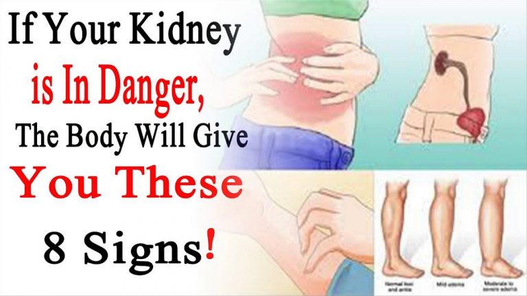 Do You Have Back Pain With Kidney Disease