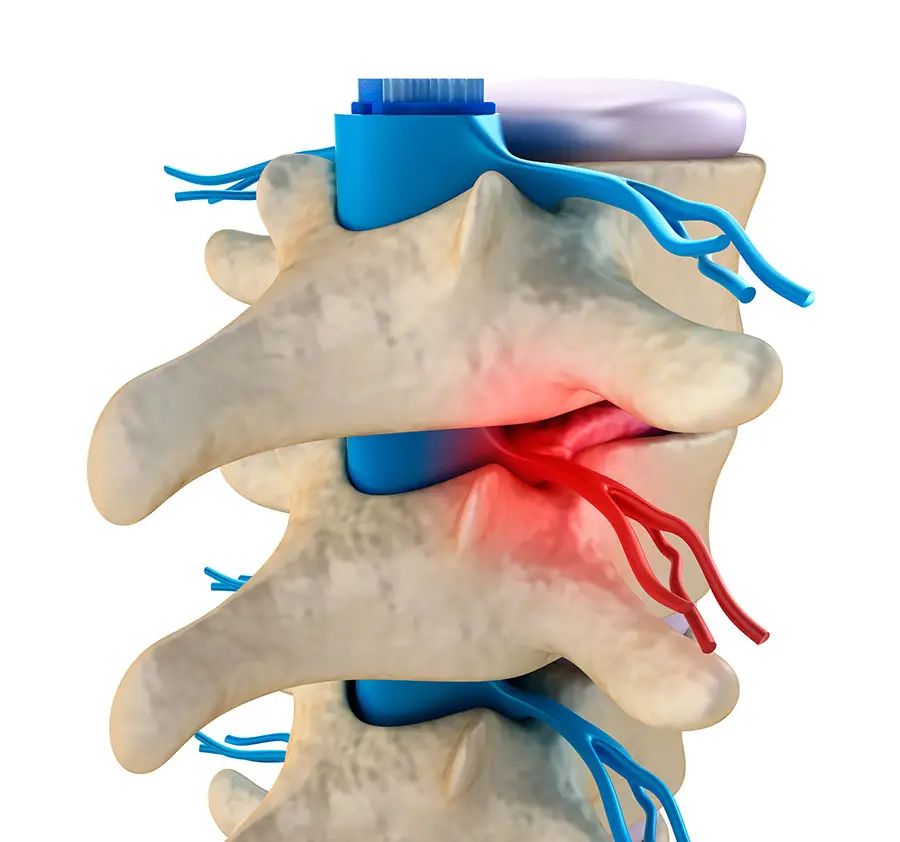 Nerve pain: Nerve injury