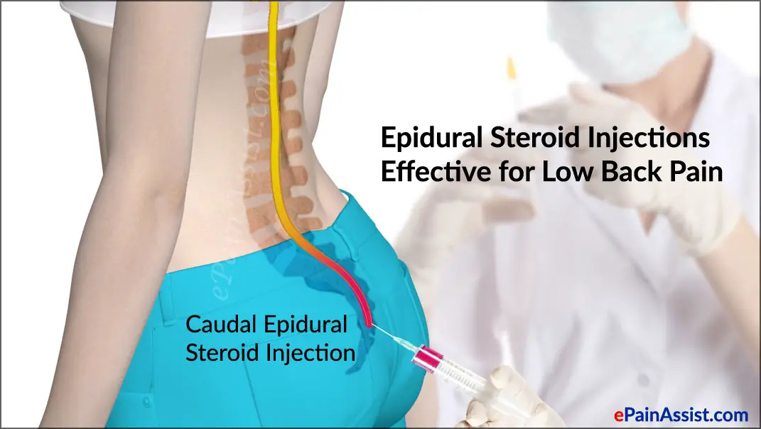 News: Study Suggests Epidural Steroid Injections Effective for Low Back ...
