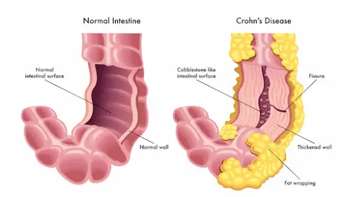 Ostomy Guidance: Crohn