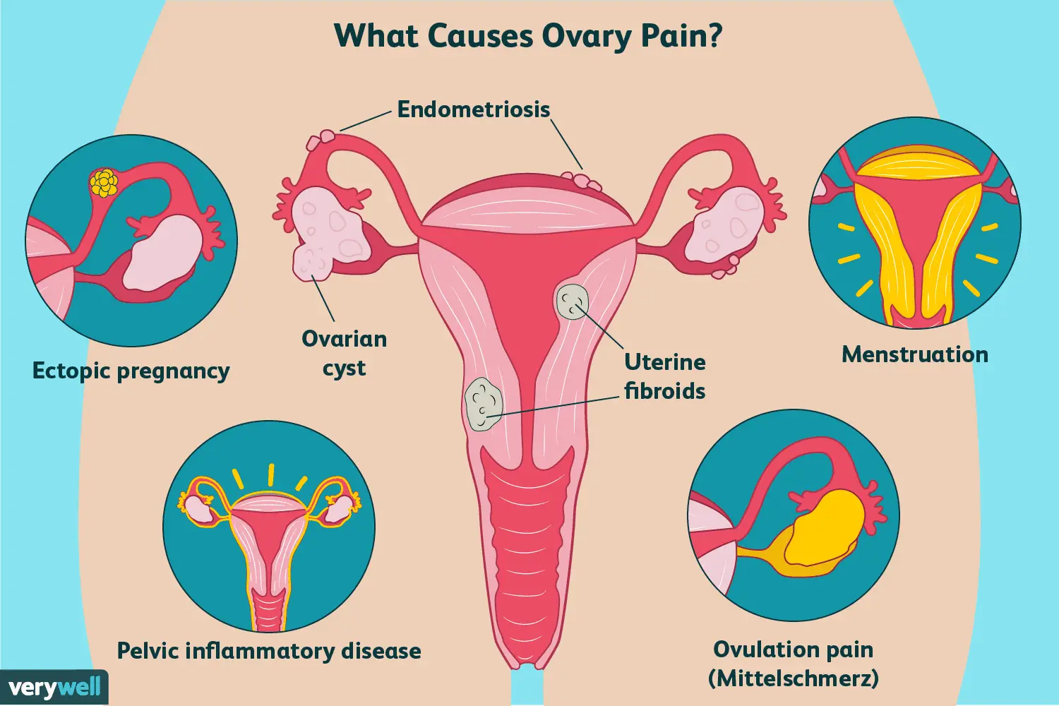 Ovary Pain: Causes, Treatment, and When to See a ...