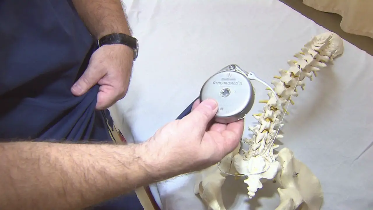 Pain pump used to deliver strong painkillers to spinal canal