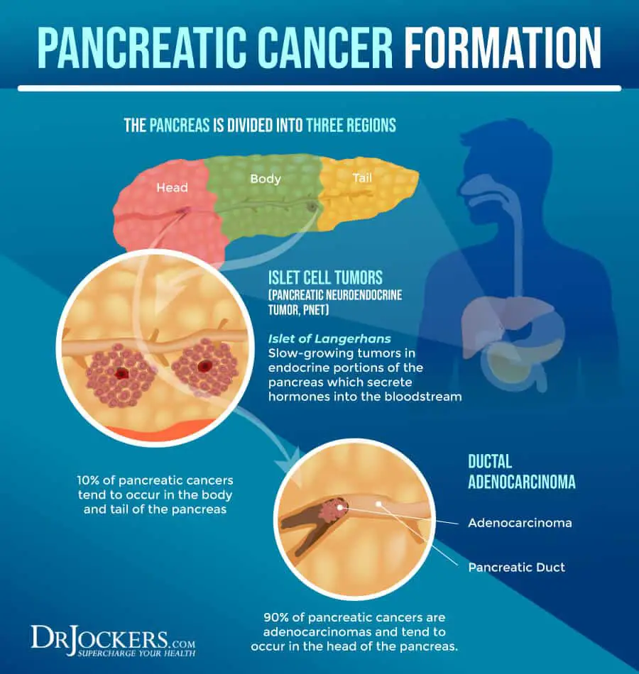 Pancreatic Cancer: Symptoms, Causes and Support Strategies