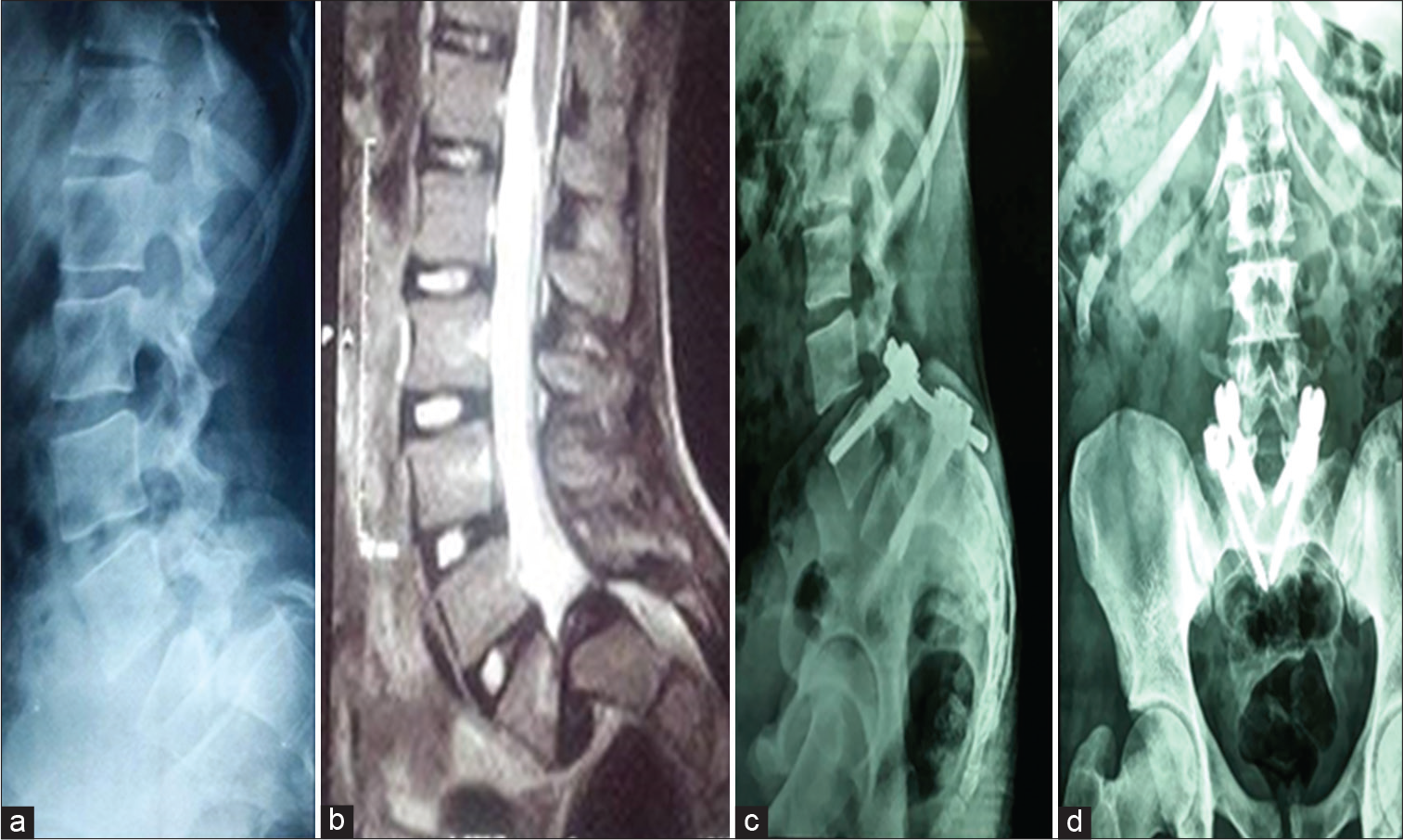 Pedicular lumbosacral spine fusion for adult/adolescent lumbar ...
