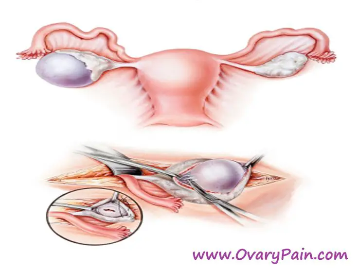 Pin on Do Ovarian Cysts Cause Back Pain