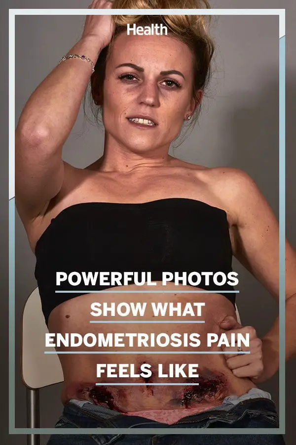 Pin on Endometriosis pain