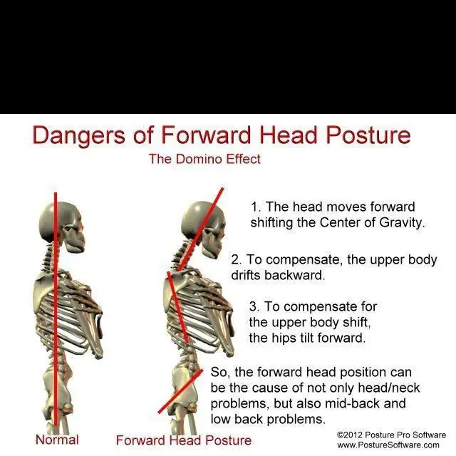 Poor posture (such as that of anterior head posture) can ...