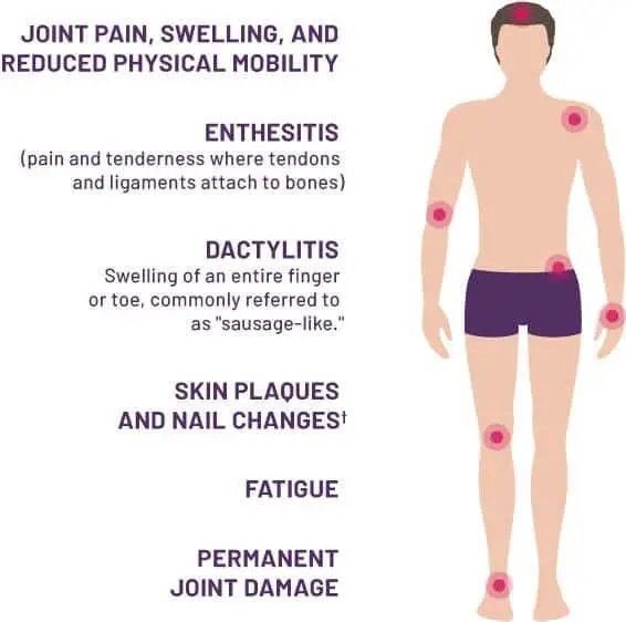 Psoriatic Arthritis Symptoms &  Information