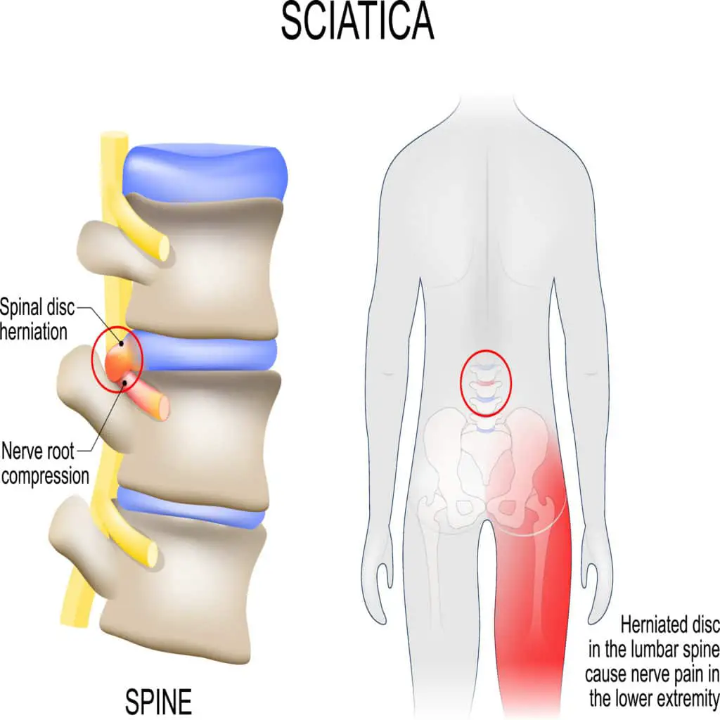 Sciatica: Causes, Symptoms, Treatment &  Prevention