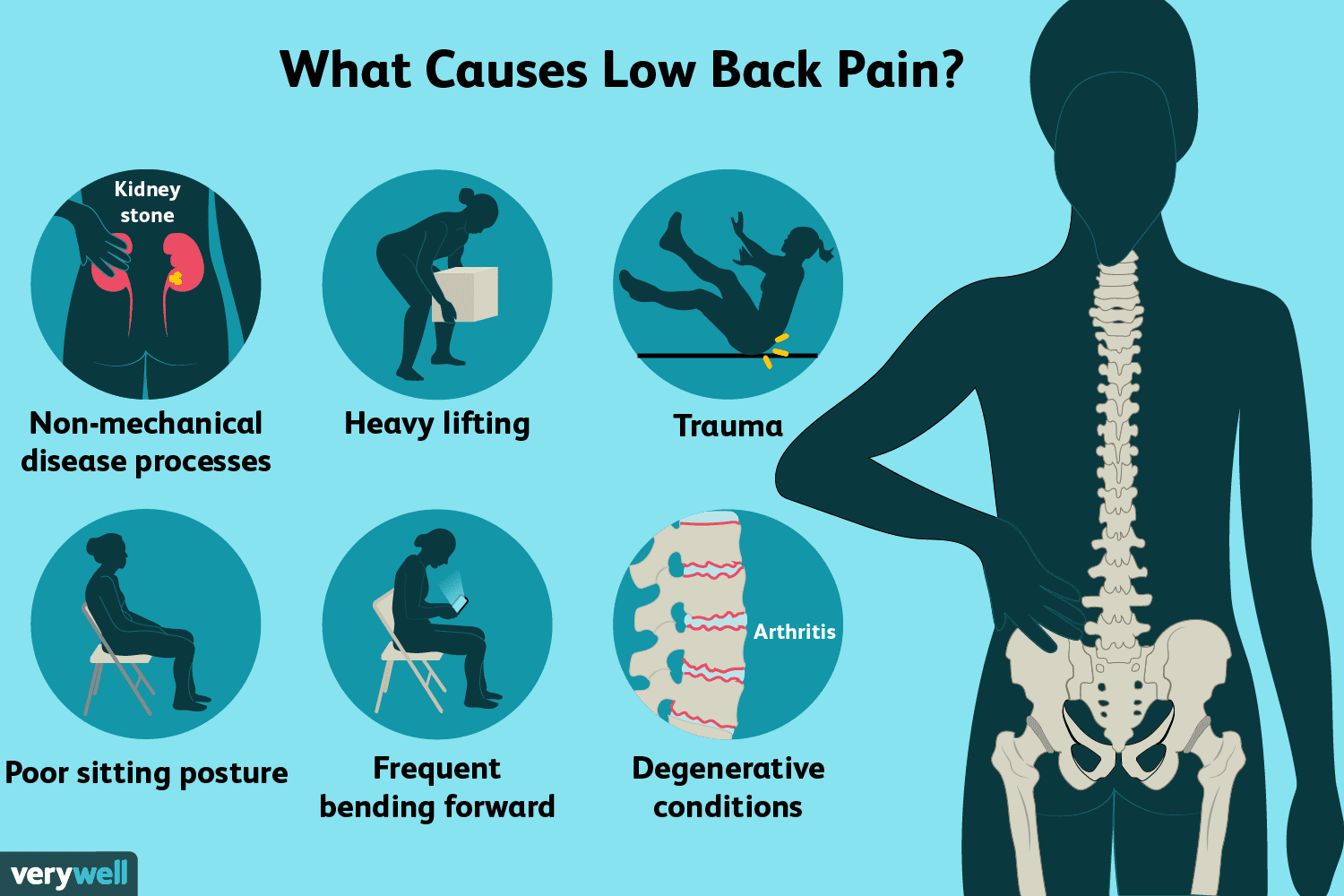 Sciatica