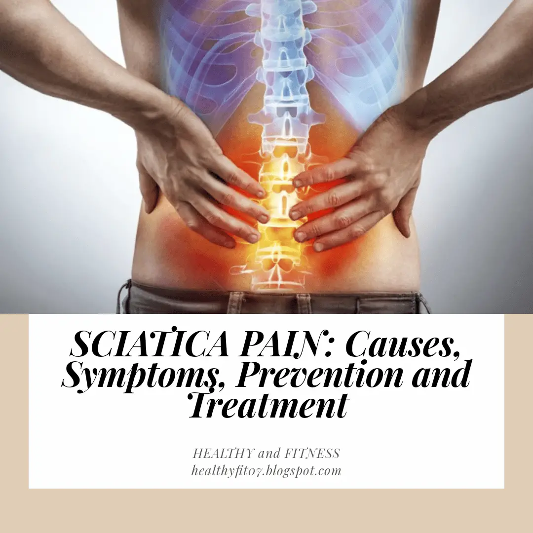 SCIATICA PAIN: Causes, Symptoms, Prevention and Treatment