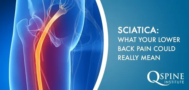 Sciatica: What Your Lower Back Pain Could Really Mean