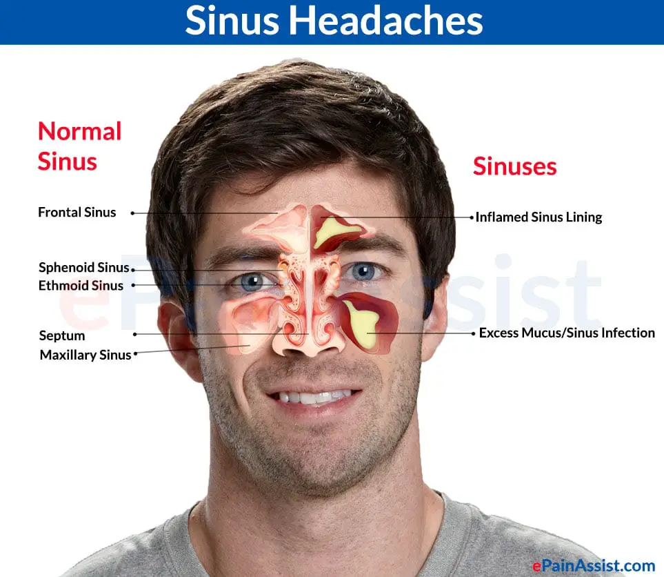 Sinus Headache No Congestion