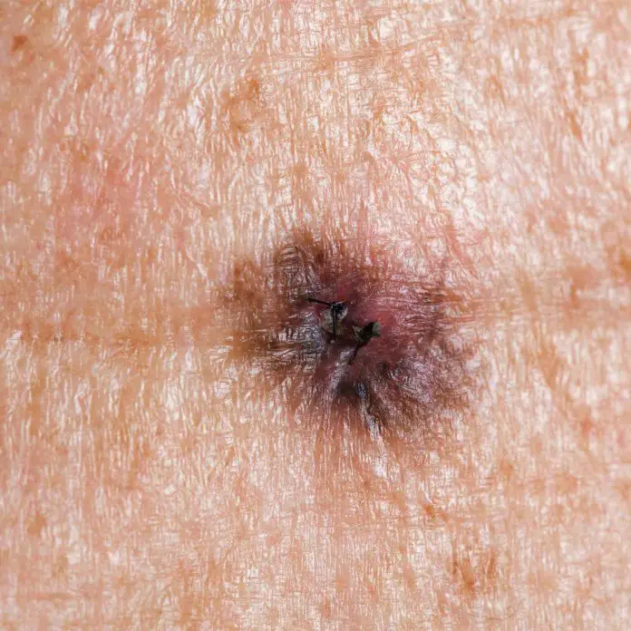 Skin Cancer: Melanoma Symptoms, Causes and Prevention