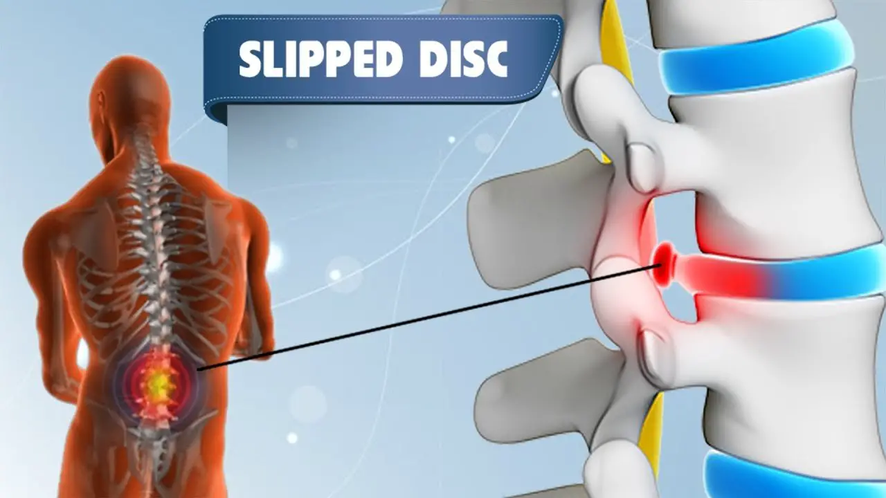 Slipped Disc Treatment in Hyderabad