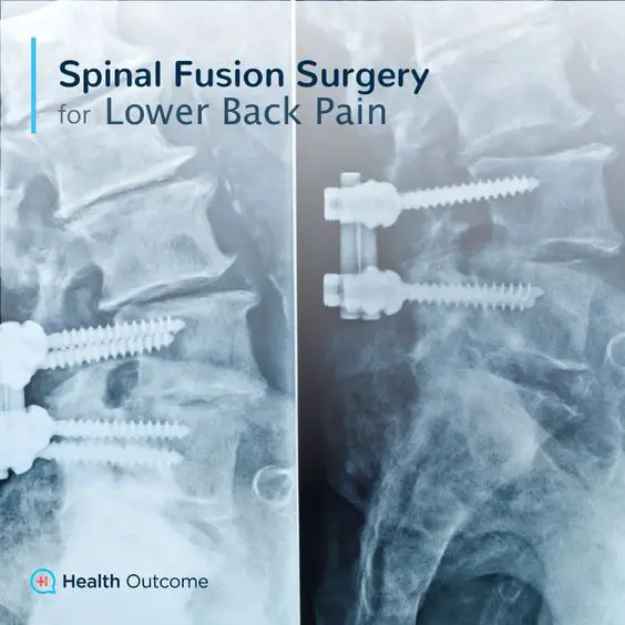 Spinal Fusion Surgery for Lower Back Pain â Spinal Fusion ...