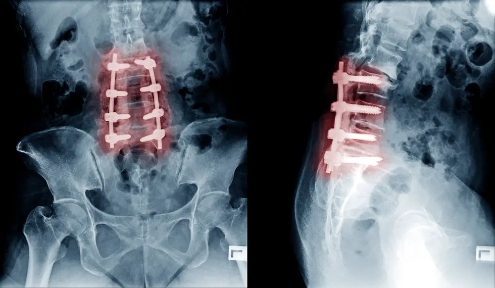 Spinal Fusion Surgery: why it might not fix your lower ...