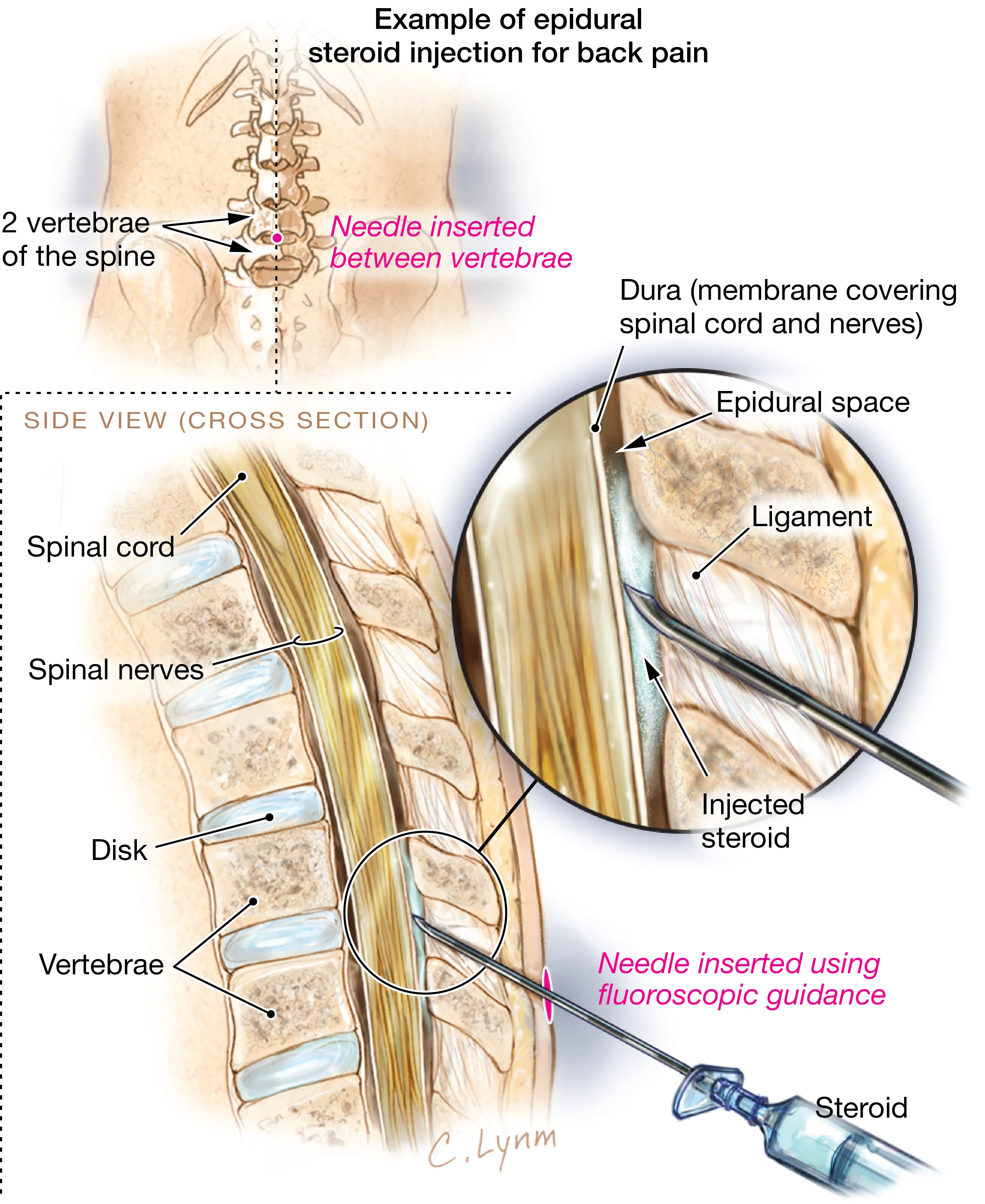 Steroid Injections to Treat Back Pain