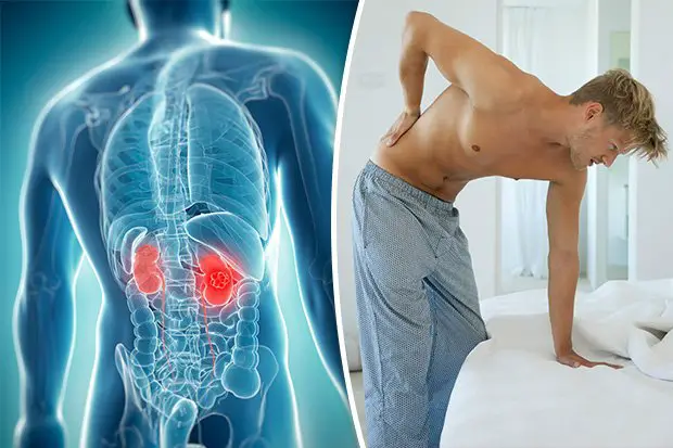 Symptoms of kidney cancer: 12 early warning signs of the life ...