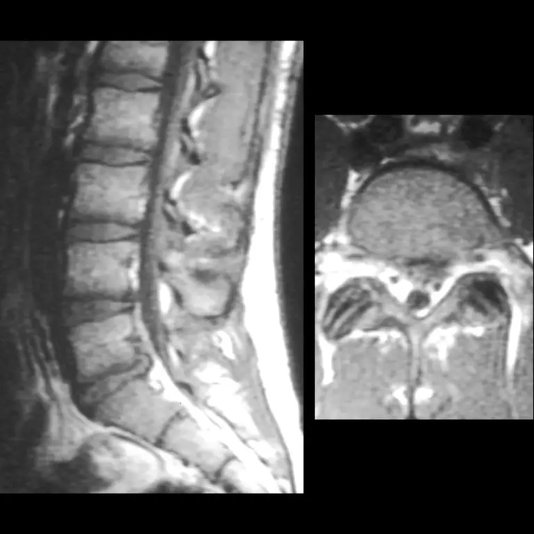 Teenager with low back pain and bilateral radicular pain for 5 months ...