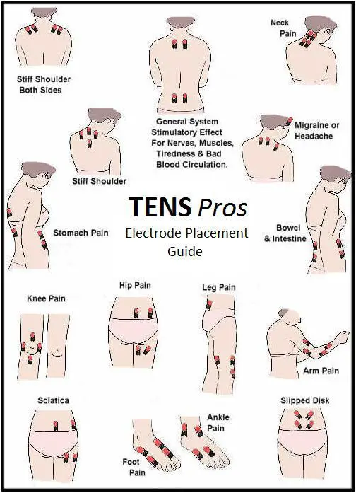 Tens Electrode Placement: What You Should Know ...