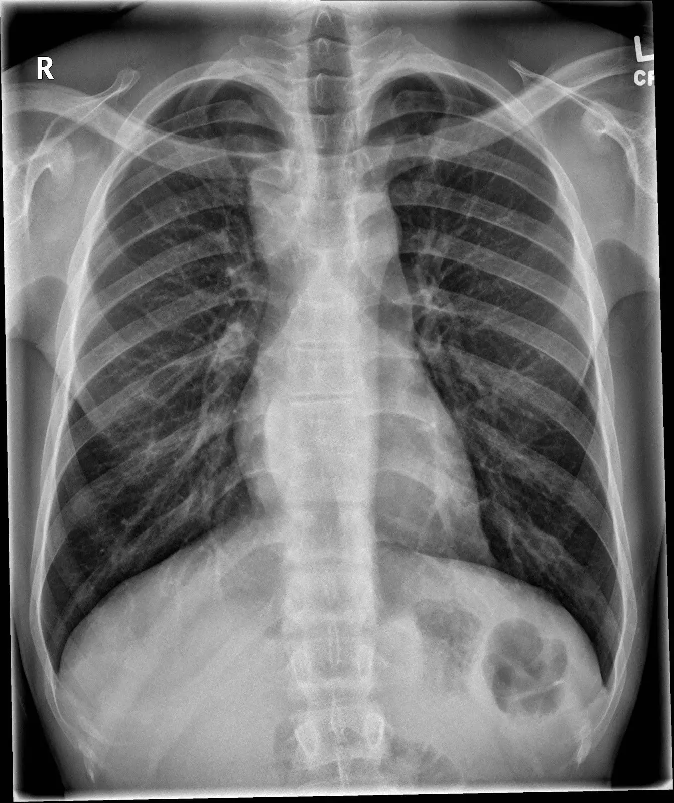 the xray doctor: xrayoftheweek 20: man with cough and back ...