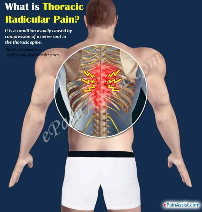 Thoracic Radicular Pain