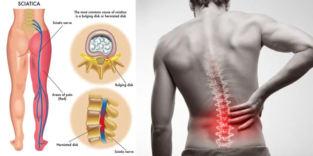 Top 10 causes of lower back pain you should know