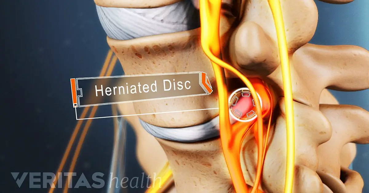 Treatment Options for a Lumbar Herniated Disc