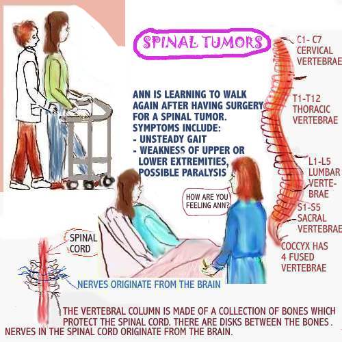 Tumor: Spinal Cord Tumor Symptoms