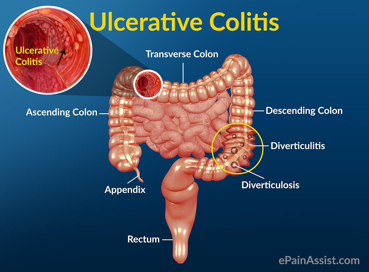 Ulcerative Colitis: Treatment, Home Remedies, Causes, Symptoms