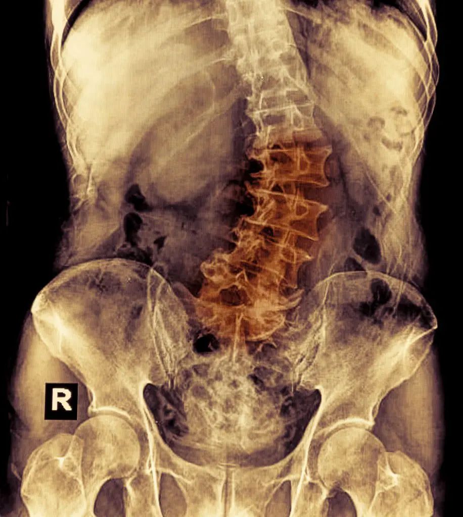 Understanding Back Pain Caused By Scoliosis