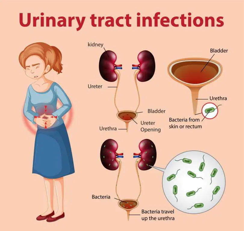 Urinary Tract Infection Online Doctor