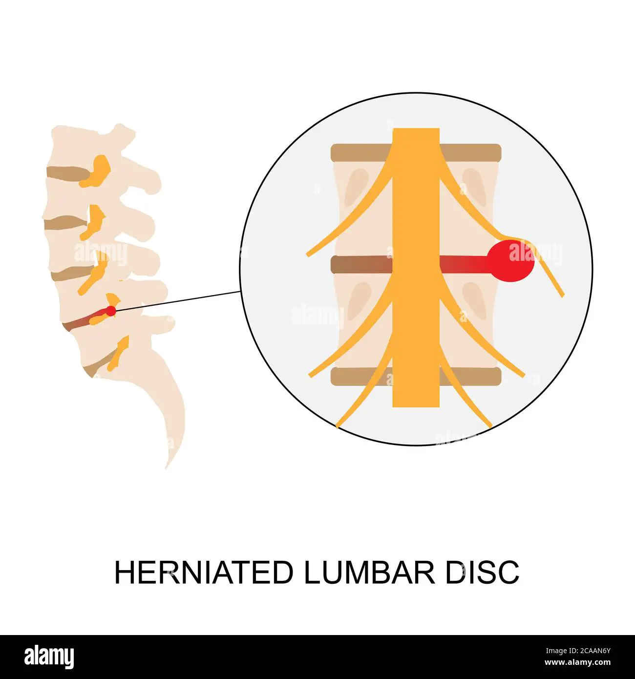Vector illustration demonstration of human herniated ...