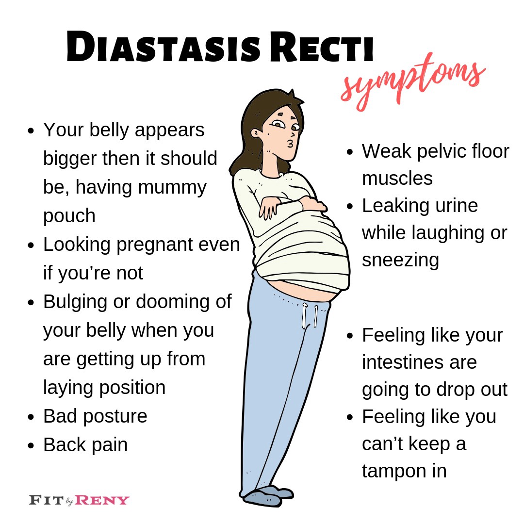 What are the symptoms of Diastasis Recti?