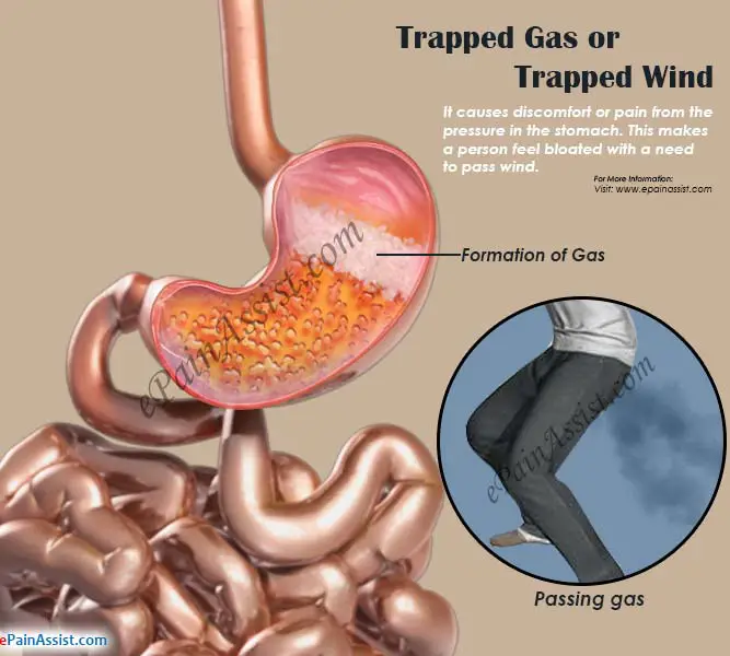What Causes Trapped Gas Pain or Trapped Wind &  Remedies to Get Rid of it?