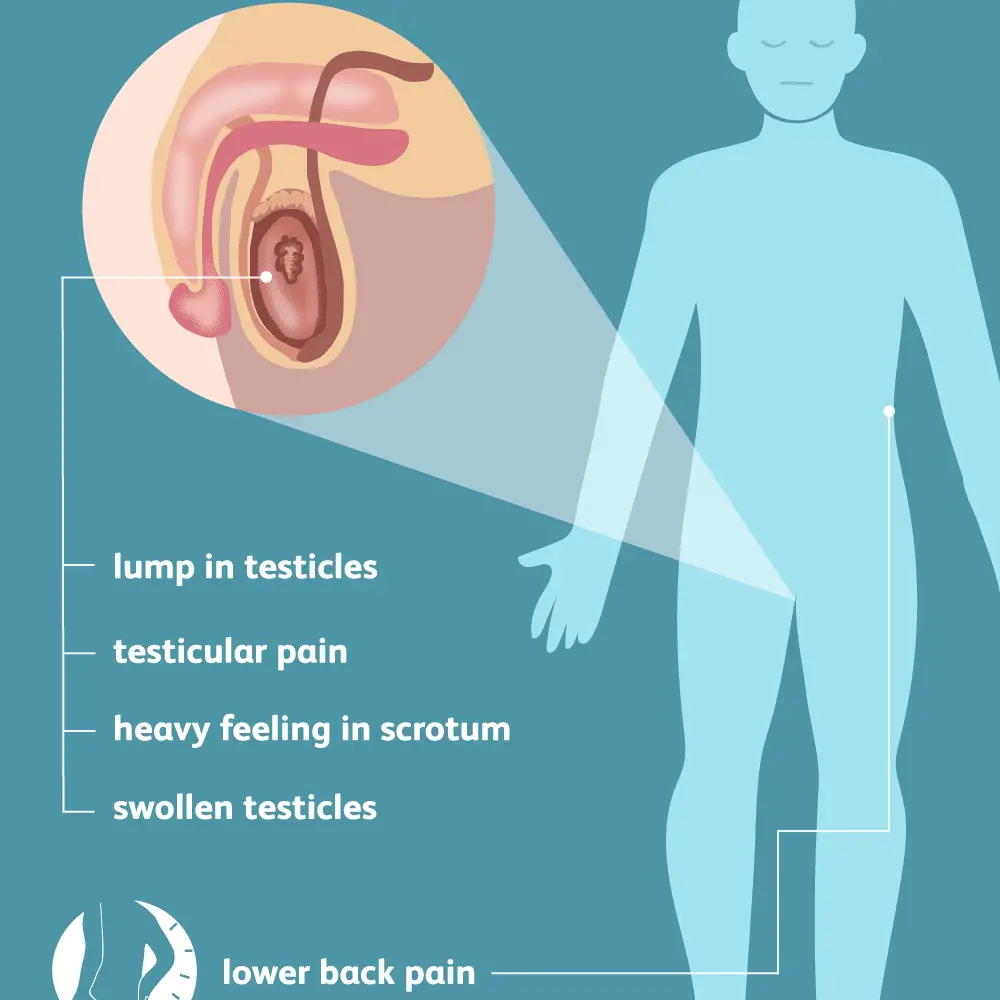 What Does Testicular Cancer Back Pain Feel Like ...