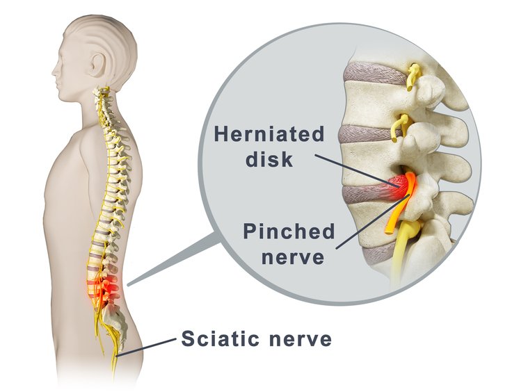 What is a Pinched Nerve? Cause &  Symptoms of a Pinched Nerve