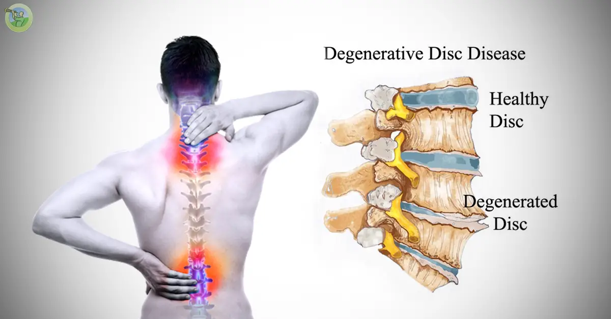 What Is Degenerative Disc Disease?