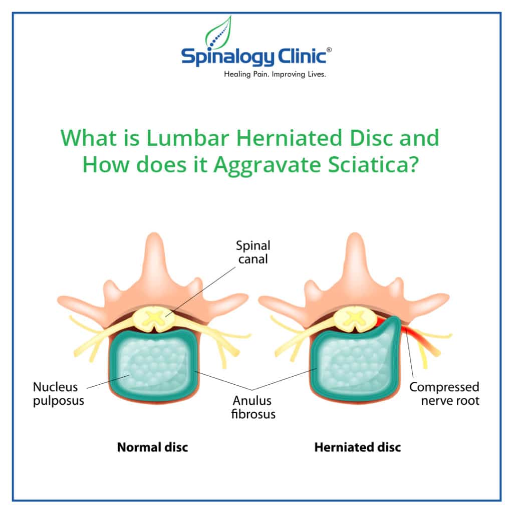 What is Lumbar Herniated Disc &  How does it aggravate Sciatica?